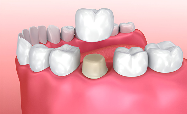 dental crowns in white rock bc