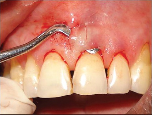 dental vista technique