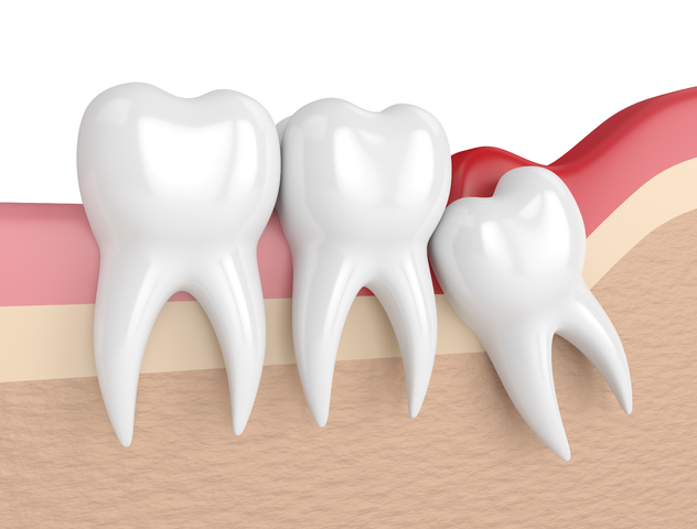 wisdom tooth extractions in white rock bc