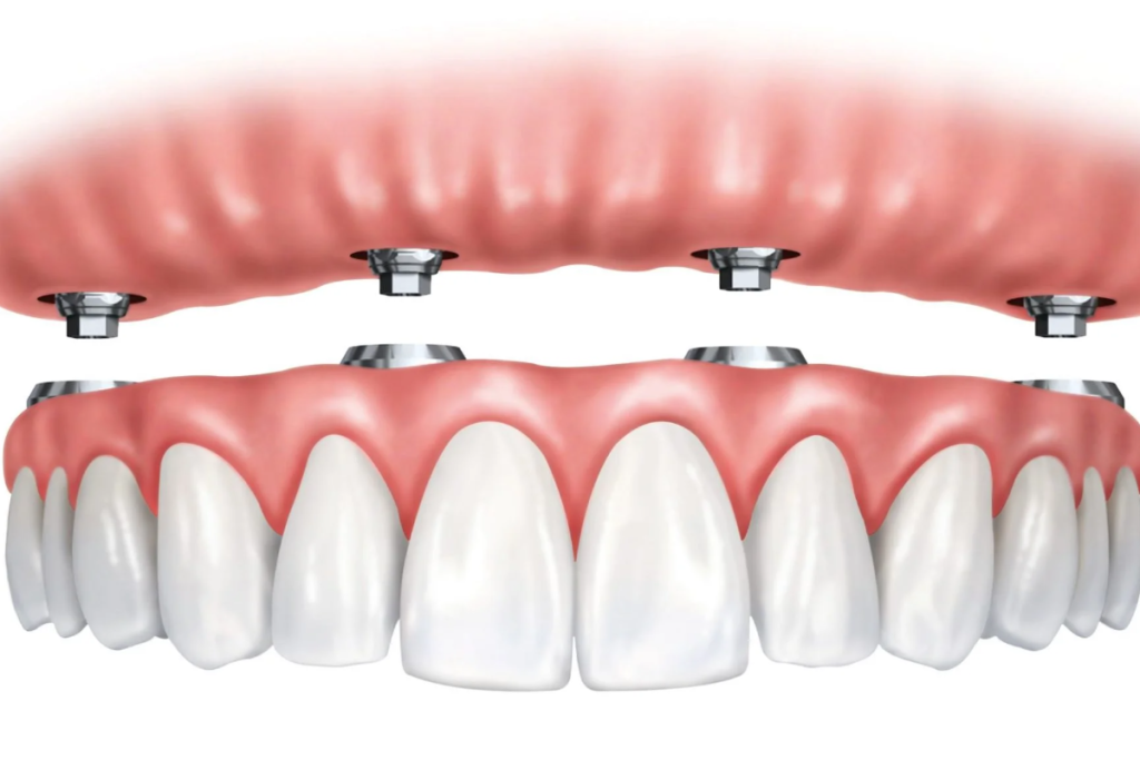 benefits of implants supported dentures