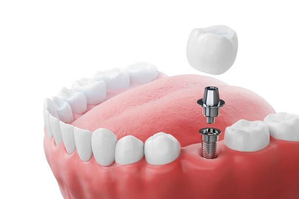 how to care for dental implants for long term success