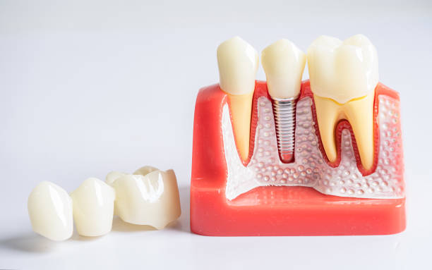 why dental implants look and feel like natural teeth